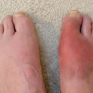 how long does a gout attack last