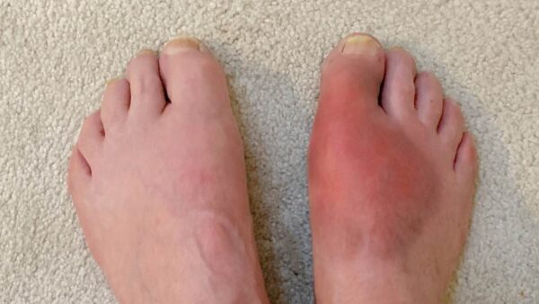 how long does a gout attack last