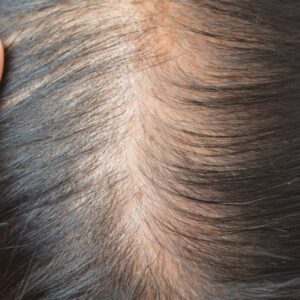how to stop thinning hair in women