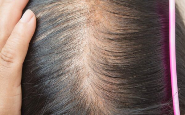 how to stop thinning hair in women