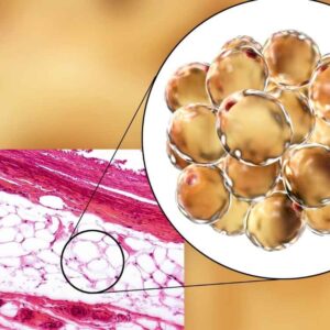 is low brown adipose tissue the root causes of unexplained weight gain