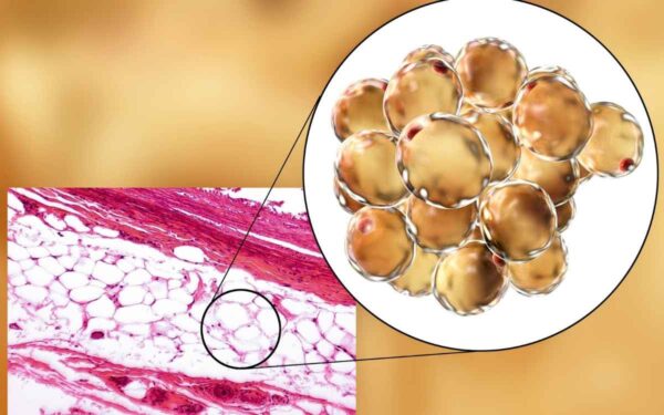 is low brown adipose tissue the root causes of unexplained weight gain